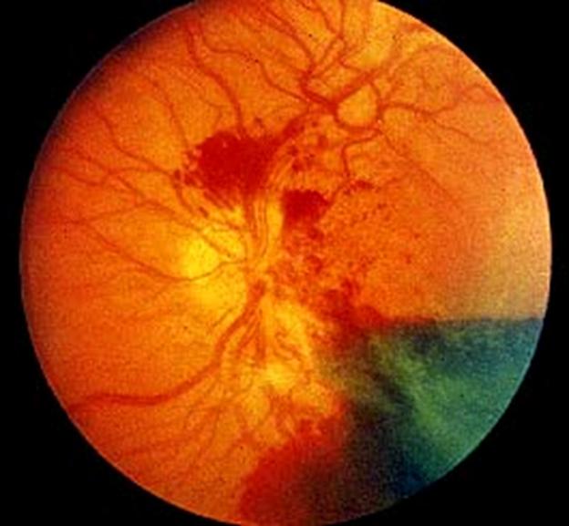 Proliferative_diabetic_retinopathy